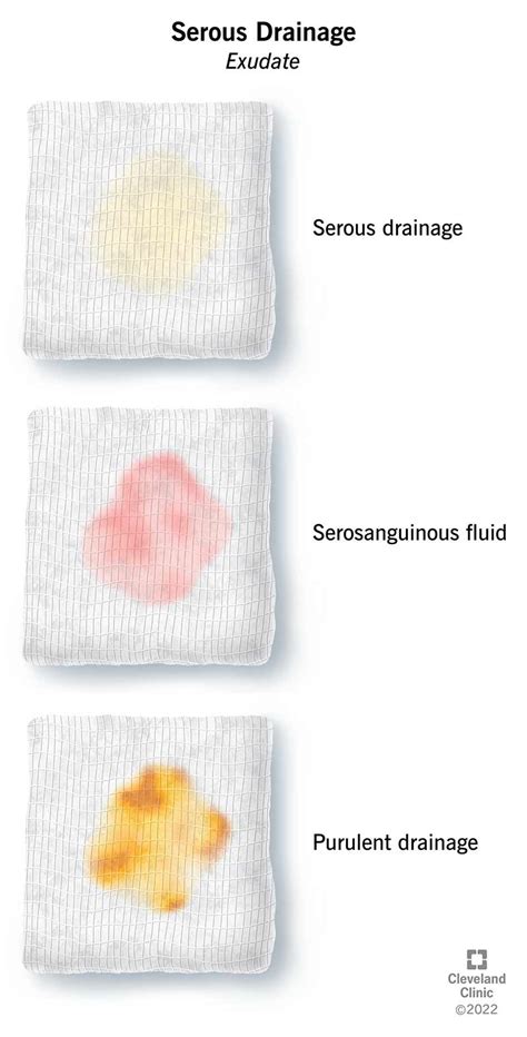 purulent drainage vs serous|Types of Wound Drainage: Identifying Features